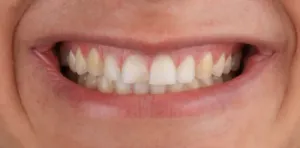 Antes - Dentes Pequenos